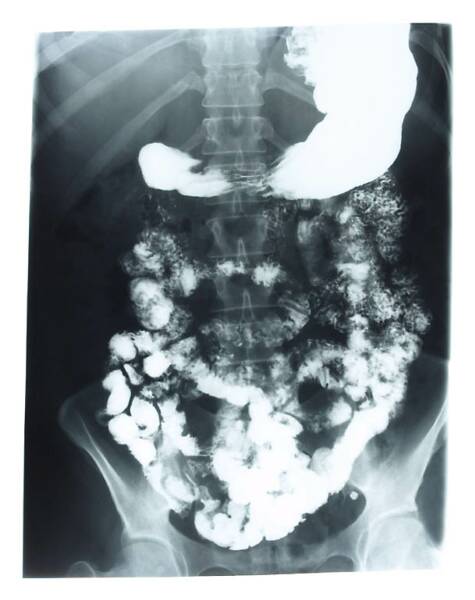 Fig 01 - X-Ray - Toxins - Burden on the Body