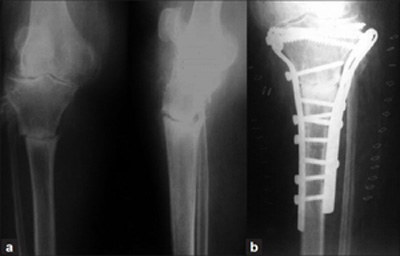 Photo - Oxygen Medicine - Wound - Tibia - Figure 1. (a) Radiograph showing stress fracture of proximal tibia; (b) Dual plating using two incisions as the fracture did not show any signs of healing with 1 month of plaster cast.