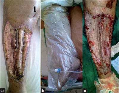 Photo - Oxygen Medicine - Wound - Tibia - Figure 2. (a) Clinical appearance of the wound at the time of presentation showing necrotic tissue and exposed bone and draining wound communicating to the knee joint (arrow); (b) Limb being exposed to topical ozone therapy; (c) Split thickness skin graft on the wound.