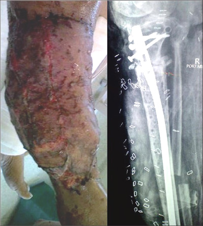 Photo - Oxygen Medicine - Wound - Tibia - Figure 3. (a) Latissimus dorsi pedicle flap was done to cover the wound and implant removal and intramedullary nailing was performed in a single stage.