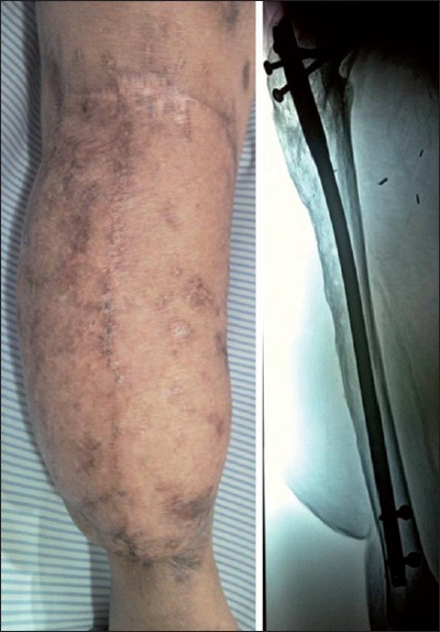 Photo - Oxygen Medicine - Wound - Tibia - Figure 4.